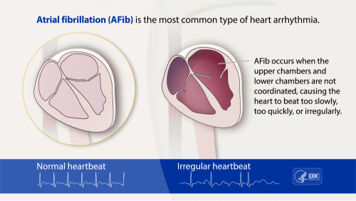 Atrial Fibrillation (A-Fib)