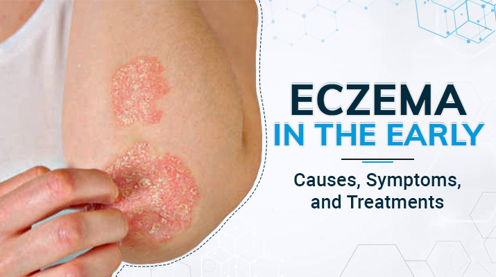 eczema