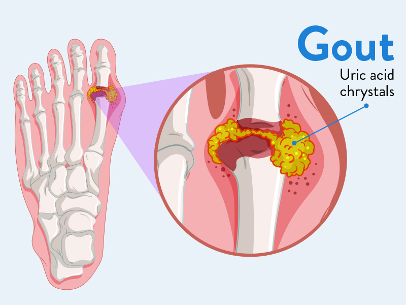 Gout Causes, Risks
