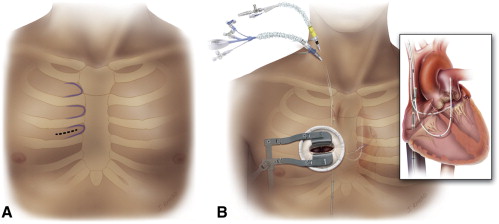 Minimally Invasive Aortic Valve Replacement (MIAVR)
