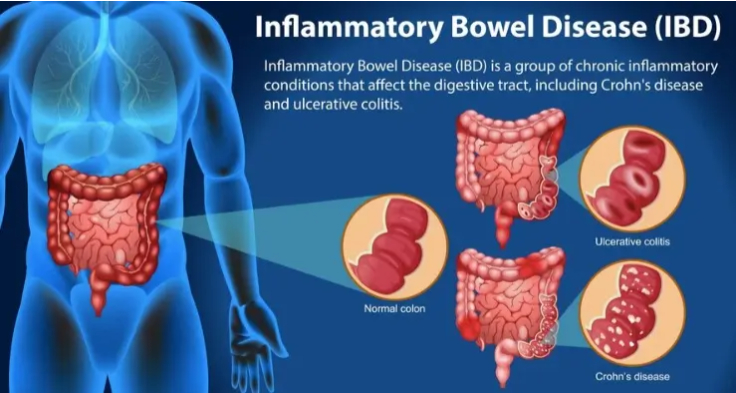 inflammatory bowel disease