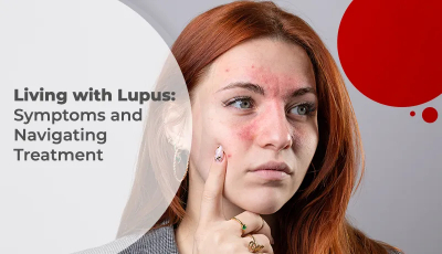 Lupus